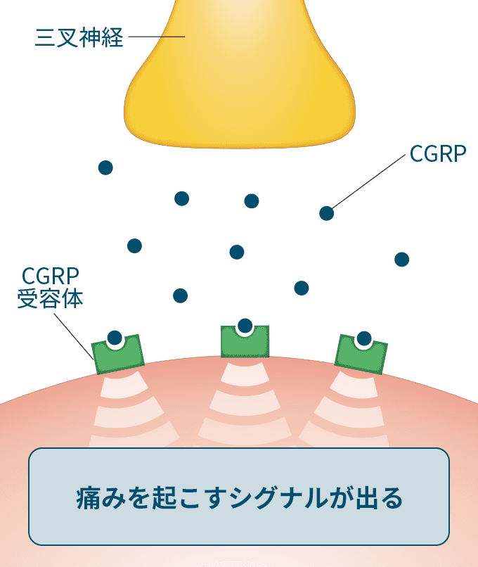 片頭痛発作時